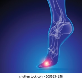 Ilustración de la articulación del tobillo de la Artritis. Artritis reumatoide.  Anatomía ósea humana ilustración vectorial plana en un fondo de tecnología azul. 3d ilustración médicamente precisa.