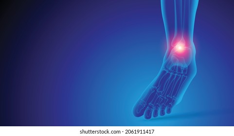 Illustration of Arthritis ankle joint . Rheumatoid arthritis.  Human bone anatomy flat vector illustration on a blue technology background. 3d rendered medically accurate illustration.