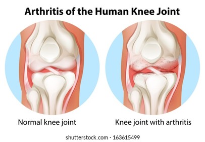 Illustration of an arthritis of the human knee joint on a white background