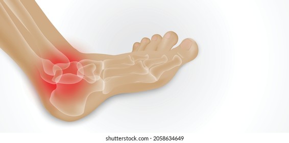 Illustration of Arthritis  joint . Rheumatoid arthritis. Pain in leg. Human bone anatomy flat vector illustration. Painful injury erosion on a white background.