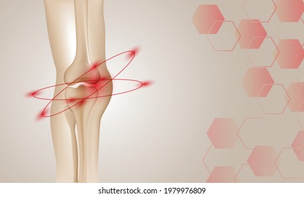 Illustration of Arthritis knee joint . Rheumatoid arthritis. Pain in leg. Human bone anatomy flat vector illustration. 