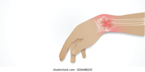 Ilustración de la articulación de la muñeca de la artritis. Artritis reumatoide. Dolor en la mano o en los dedos. Anatomía ósea humana ilustración vectorial plana. Erosión dolorosa de la lesión sobre un fondo blanco.