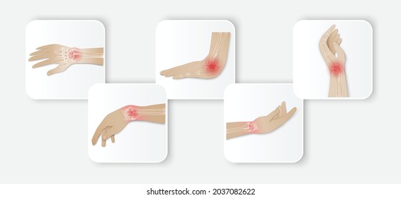 Ilustración de la articulación de la muñeca de la artritis. Artritis reumatoide. Dolor en la mano o en los dedos. Anatomía ósea humana ilustración vectorial plana. Erosión dolorosa de la lesión sobre un fondo blanco.
