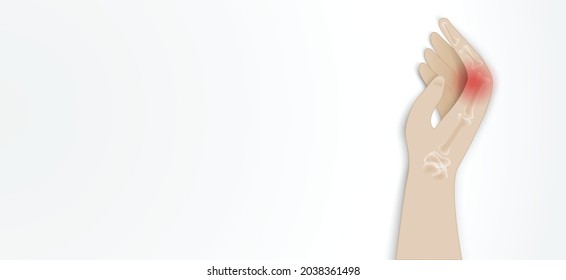 Illustration of Arthritis wrist joint . Rheumatoid arthritis. Pain in hand or fingers. Human bone anatomy flat vector illustration. Painful injury erosion on a white background.