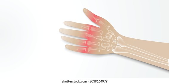 Illustration of Arthritis wrist joint . Rheumatoid arthritis. Pain in hand or fingers. Human bone anatomy flat vector illustration. Painful injury erosion on a white background.