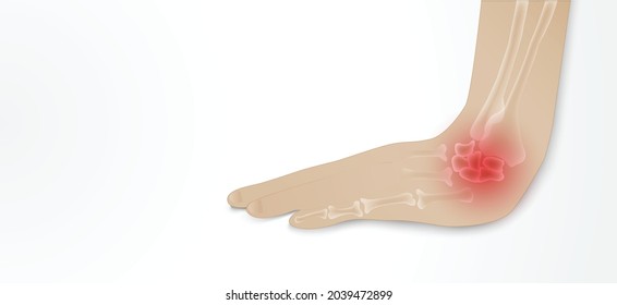 Illustration of Arthritis wrist joint . Rheumatoid arthritis. Pain in hand or fingers. Human bone anatomy flat vector illustration. Painful injury erosion on a white background.