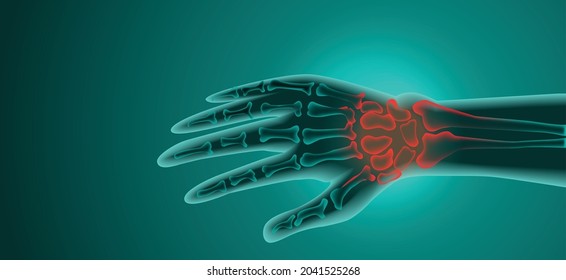 Ilustración de la articulación de la muñeca de la artritis. Artritis reumatoide. Dolor en la mano o en los dedos. Anatomía ósea humana ilustración vectorial plana. La dolorosa erosión de la lesión en un contexto de tecnología verde.