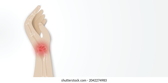 Illustration of Arthritis wrist joint . Rheumatoid arthritis. Pain in hand or fingers. Human bone anatomy flat vector illustration. Painful injury erosion on a white background.