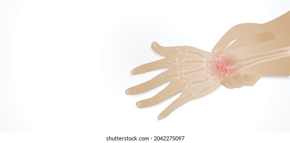 Illustration of Arthritis wrist joint . Rheumatoid arthritis. Pain in hand or fingers. Human bone anatomy flat vector illustration. Painful injury erosion on a white background.