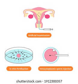 Illustration of artificial insemination, in vitro fertilization, and Intracytoplasmic sperm injection