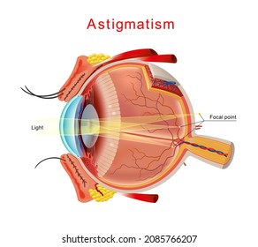 Illustration of astigmatism. Astigmatism is a blurred vision. Anatomy of the eye, cross section. Isolated Vector.