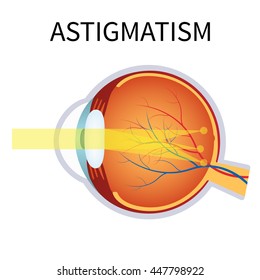 20,209 Astigmatism Images, Stock Photos & Vectors | Shutterstock