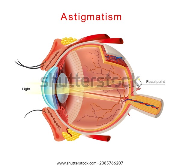 Illustration of\
astigmatism. Astigmatism is a blurred vision. Anatomy of the eye,\
cross section. Isolated\
Vector.