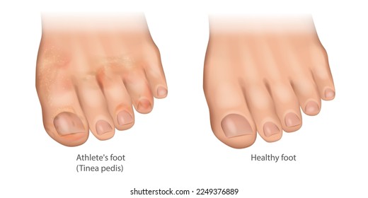 Ilustración del pie y pie sano del atleta. Línea pedis o oruga del pie, pie mosco. Infección cutánea de los pies causada por un hongo.