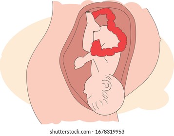 Illustration of a baby coming out of mother's belly.