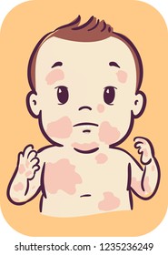 Illustration of a Baby Kid Boy with Skin Rashes All Over His Face and Body