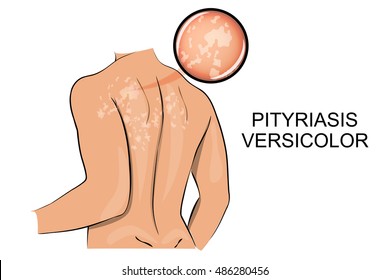 illustration of the back, the affected pityriasis  versicolor. dermatology.
