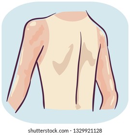 Illustration of a Back of a Man with Sunburn on Arms and Neck