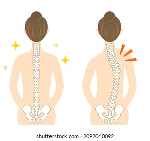 Illustration of the back of a woman with scoliosis and a bent spine