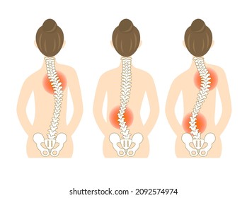 Illustration Of The Back Of A Woman With Scoliosis And A Bent Spine