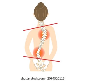 Illustration of the back of a woman with scoliosis and a bent spine