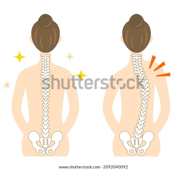 Illustration Back Woman Scoliosis Bent Spine Stock Vector (Royalty Free ...