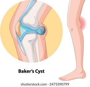 Illustration of a Baker's cyst in the knee