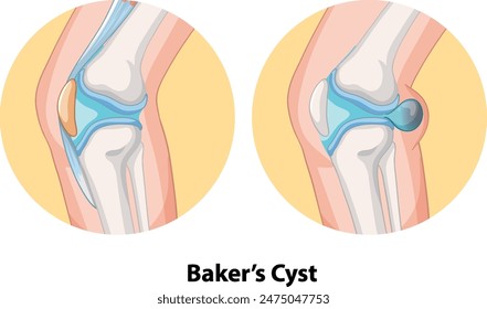 Ilustración de quiste de Baker en articulación de rodilla