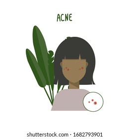 Illustration of a beautiful girl with acne. Young woman and foliage behind. Girl shows her skin and face. Vector illustration, skin features.