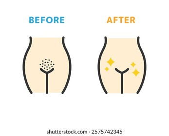 Illustration of before and after icons (line drawing color) for V-line hair removal.