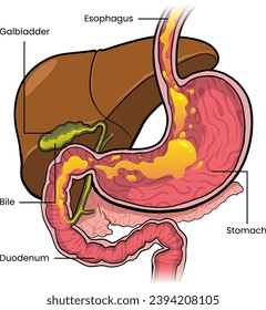 illustration of bile reflux diagram