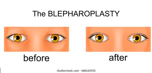 illustration of a blepharoplasty. before and after surgery. lift
