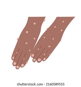 Illustration of blistered skin and hands 