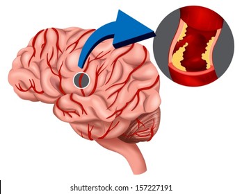 Illustration Of A Blood Clot Concept In The Brain On A White Background