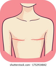 Illustration Of A Body With Linear Scars Due To Mastectomy Breast Surgery