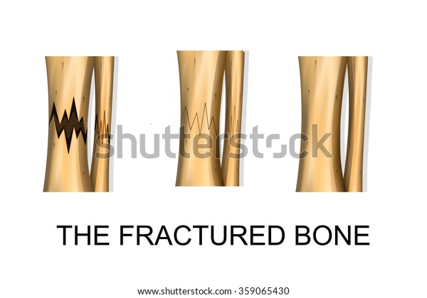 Illustration Bone Fracture Fracture Healing Stock Vector Royalty Free Illustration Bone Fracture Fracture Healing Stock Vector Royalty Free