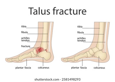 Illustration of bone fractures. Anatomical structure of the human foot with a painful part