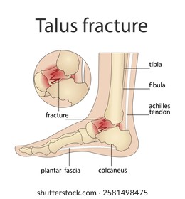 Illustration of bone fractures. Anatomical structure of the human foot with a painful part