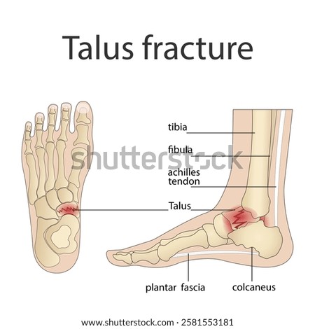 Illustration of bone fractures. Anatomical structure of the human foot with a painful part
