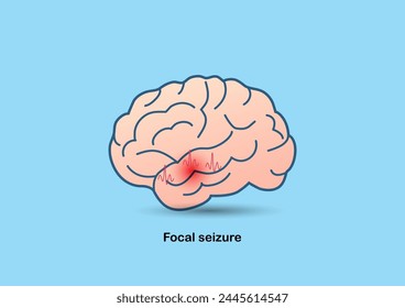 Illustration of brain and abnormal brain waves symbolizing focal epilepsy.