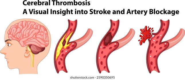 Illustration of brain, arteries, and blockage process