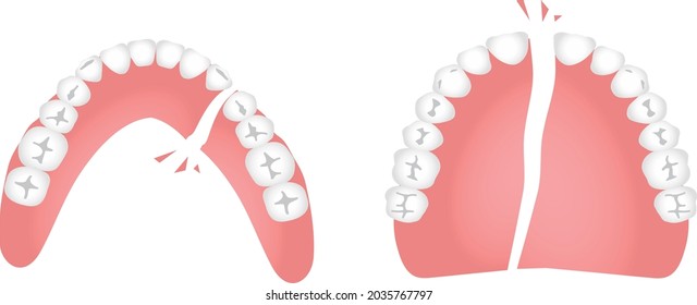 The illustration of broken dentures