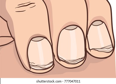 Illustration Of Broken Nail