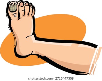 Eine Illustration eines gebrochenen Zehennagels.