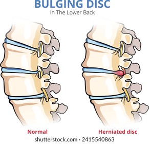 illustration of bulging disc in the lower back