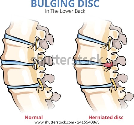 illustration of bulging disc in the lower back