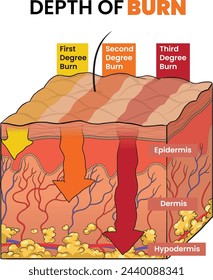 Illustration of burn degree level, depth of burn degree - vector