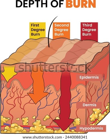 Illustration of burn degree level, depth of burn degree - vector