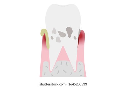 46 Alveolar bone loss Images, Stock Photos & Vectors | Shutterstock