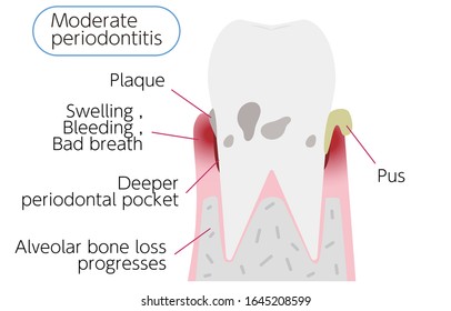 Illustration by stage of periodontal disease: moderate periodontitis